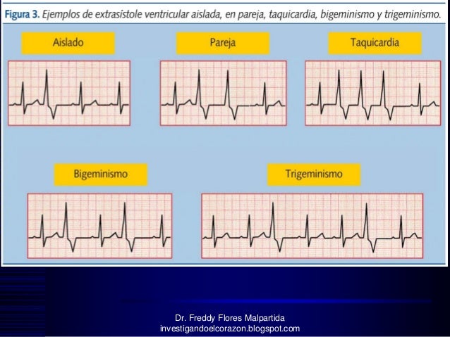 Bigeminismo Ventricular Tratamiento Pdf Download